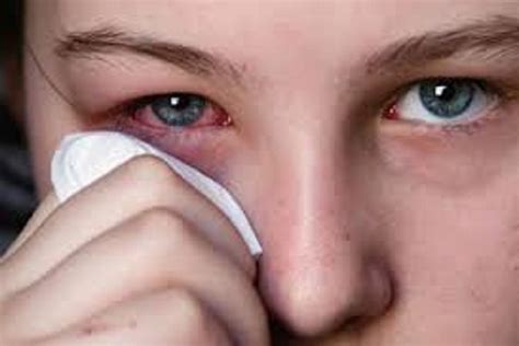 sakit mata akibat kelelahan atau mata kering
